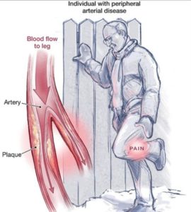 Peripheral Arterial Disease Chicago IL | PAD Treatment